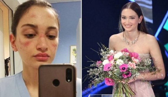 U bë e famshme më selfien me shenjat e maskës në fytyrë, infermierja me mesazh emocionues në Sanremo