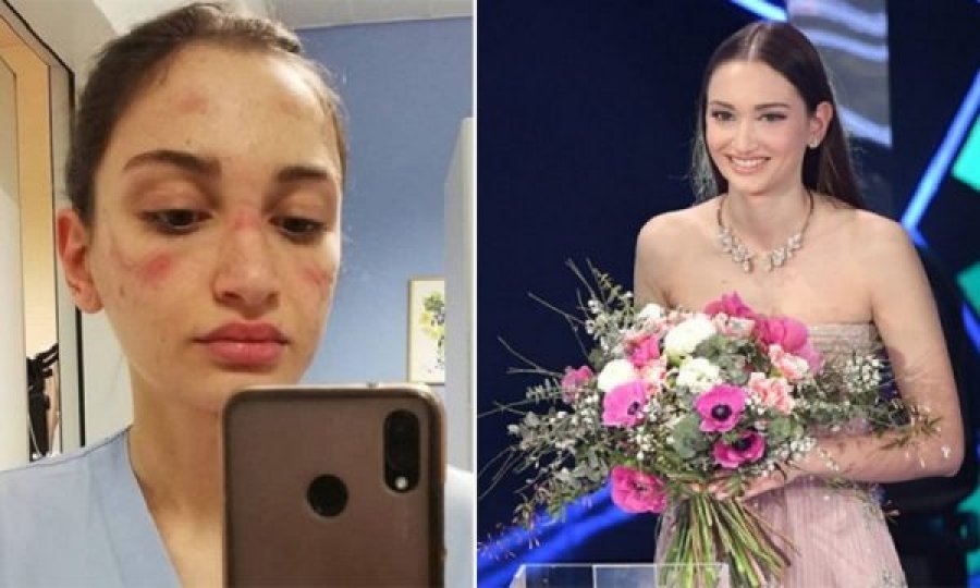 U bë e famshme më selfien me shenjat e maskës në fytyrë, infermierja me mesazh emocionues në Sanremo