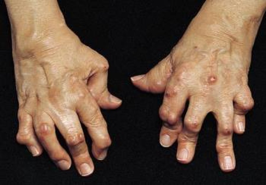 Metodë e re për diagnostikimin e artritit