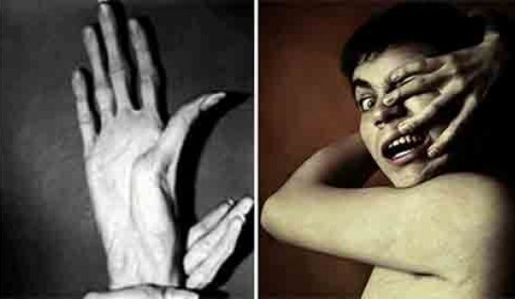  Çfarë është sindroma e dorës së alienit? 