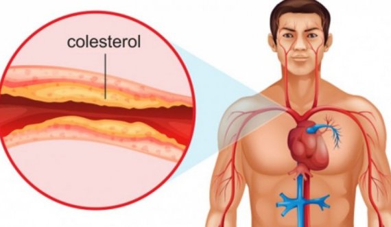 Kolesteroli i lartë, por edhe mungesa e tij, janë të dëmshëm