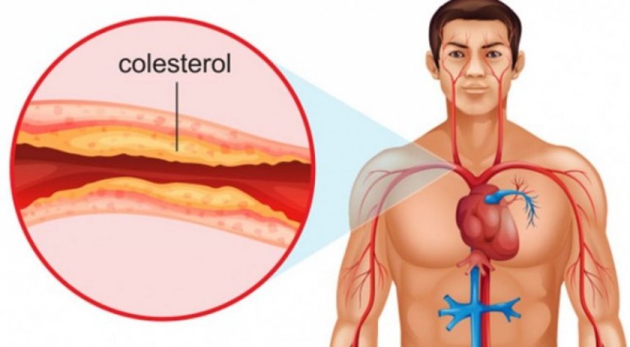Kolesteroli i lartë, por edhe mungesa e tij, janë të dëmshëm