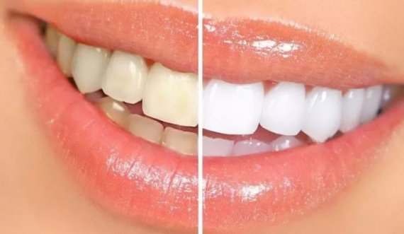 Sekreti absolut për dhëmbët e bardhë: Provoni këtë recetë të bërë në shtëpi dhe do të argëtoheni