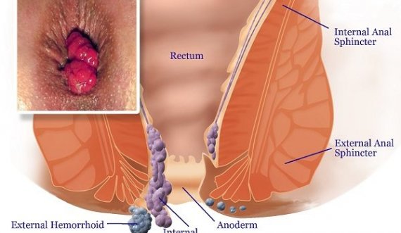 Si t'ia dilni mbanë me hemorroidet?