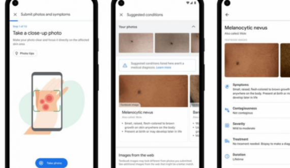 Një mjet në Google mund t’i ndihmojë njerëzit të identifikojnë problemet në lëkurë