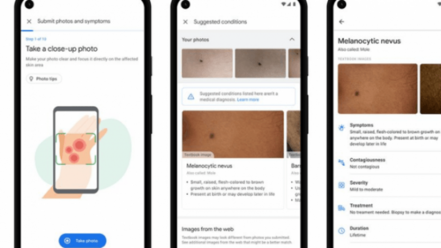 Një mjet në Google mund t’i ndihmojë njerëzit të identifikojnë problemet në lëkurë