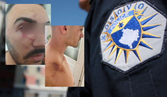 Vazhdon dhuna brutale e Policisë së Kosovës: I bëjnë për spital tre të rinj