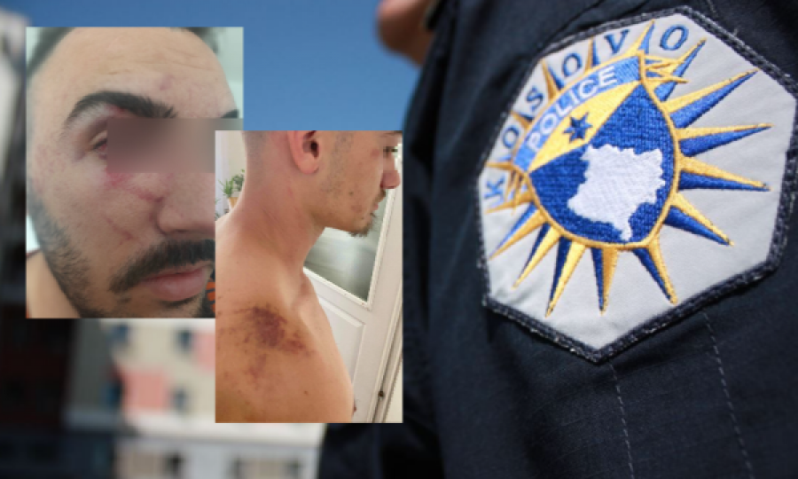 Vazhdon dhuna brutale e Policisë së Kosovës: I bëjnë për spital tre të rinj
