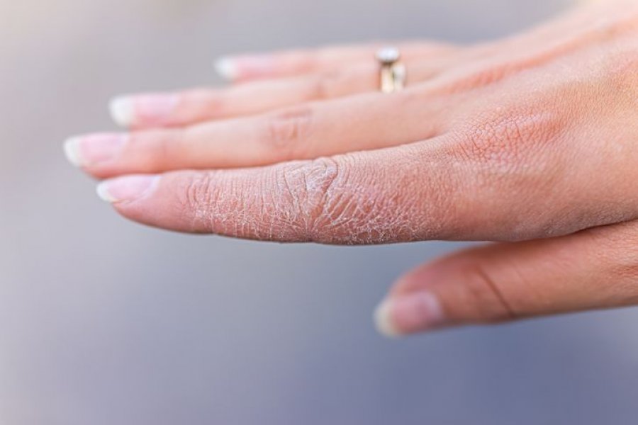 Gjashtë mënyra për të trajtuar duart tuaja të thara dhe të plasaritura në shtëpi