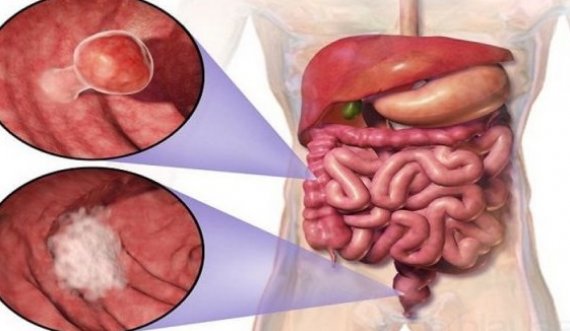 Simptomat e kancerit në zorrë të trashë 