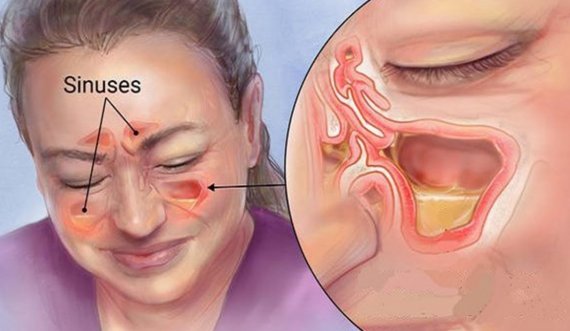 Çfarë janë sinuset?