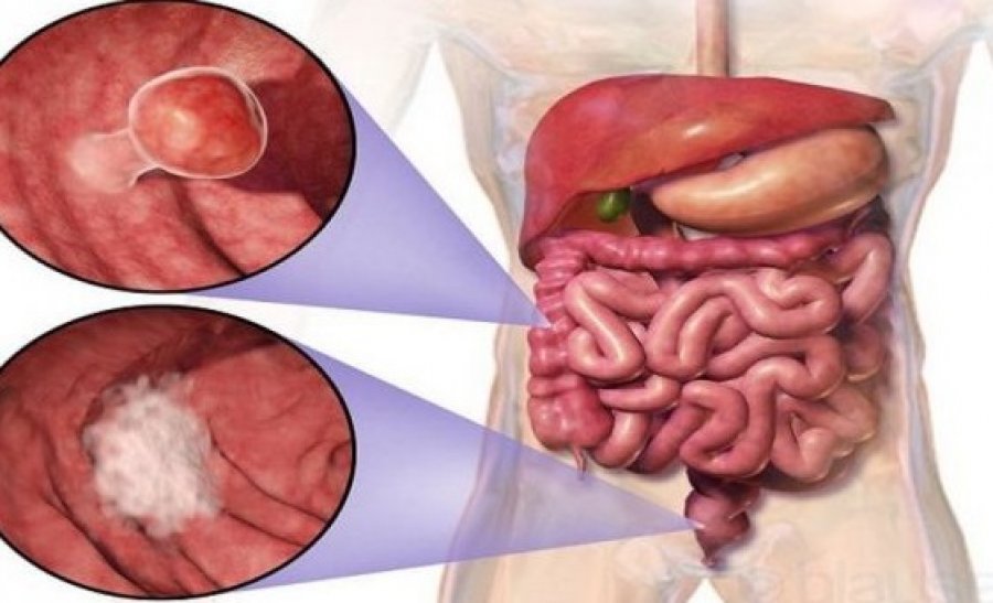Simptomat e kancerit në zorrë të trashë 