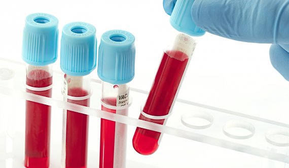 Prezantohet një test i ri gjaku që mund të zbulojë 50 lloje të kancerit përpara se të shfaqen simptomat