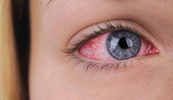 Ilaçet kundër akneve mund ta dëmtojnë shikimin