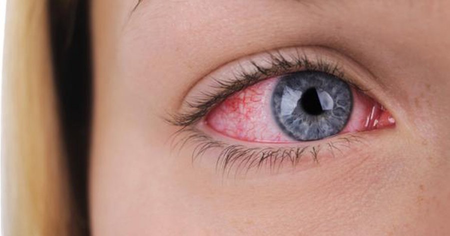 Ilaçet kundër akneve mund ta dëmtojnë shikimin