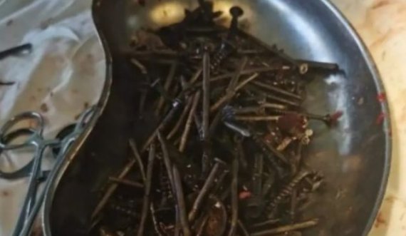 Mbi 1 kg vida dhe gozhdë në stomakun e pacientit, shokohen mjekët