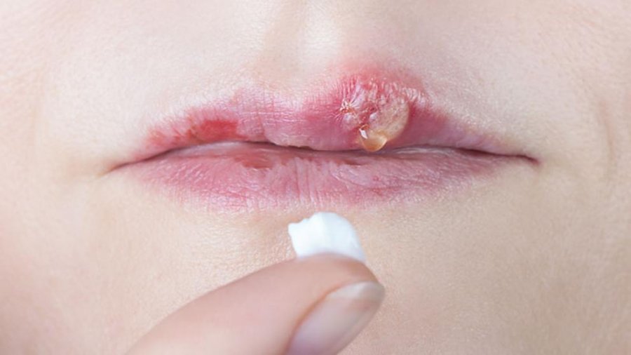 Herpesi në buzë: Metoda parandalimi dhe trajtimi