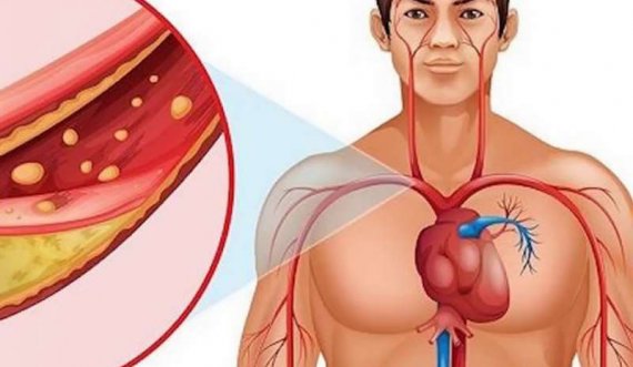 Simptomat që zbulojnë nëse keni arteriet e bllokuara 