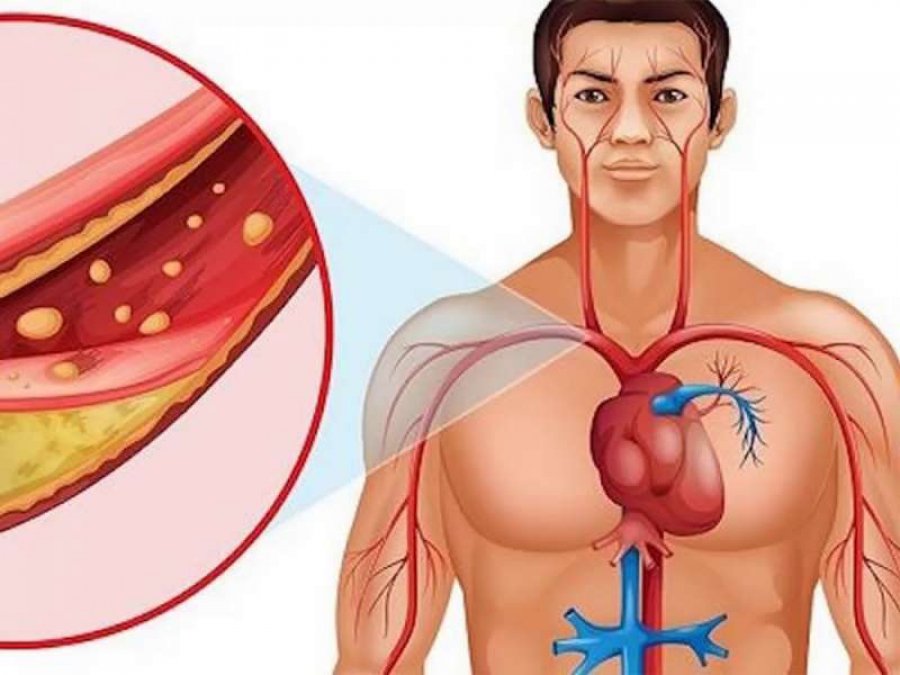 Simptomat që zbulojnë nëse keni arteriet e bllokuara 