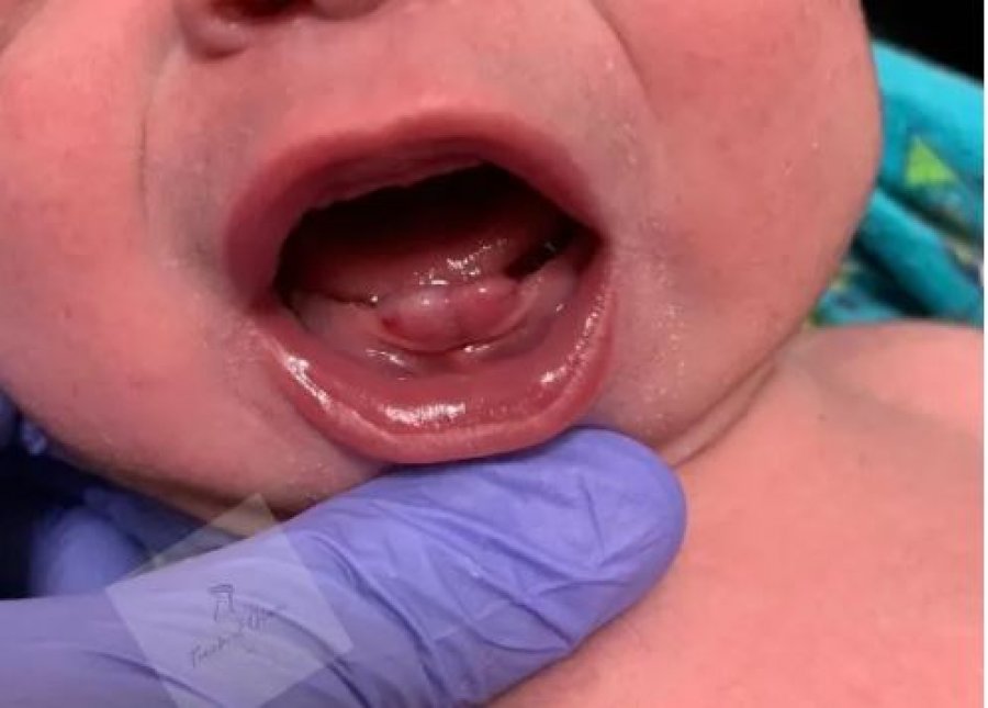 Foshnjat mund të lindin me dhëmbë! Ekspertët paralajmërojnë nënat: Ja çfarë duhet të keni kujdes që të vegjlit të mos rrezikojnë jetën