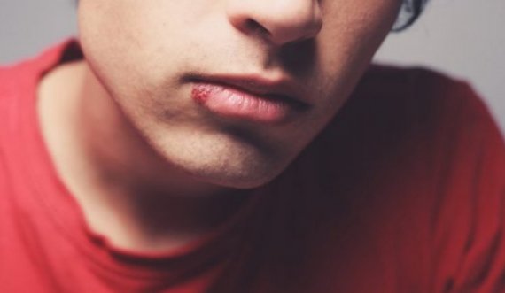 Keni herpes në buzë, çfarë po ndodh në organizmin tuaj?