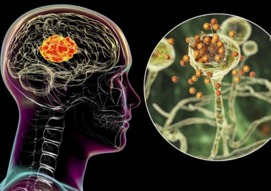 Studimi i ri/ Pasi të keni kaluar COVID-19 duhet patjetër të konsultoheni me një neurolog, ja pse