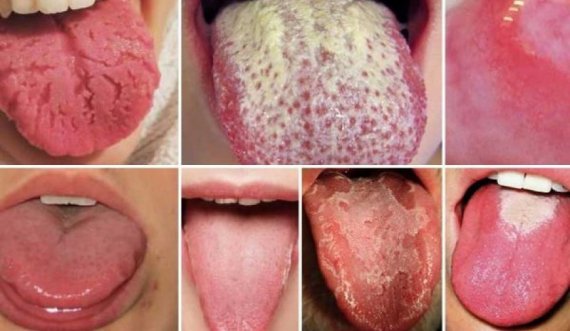 Kanceri: Problemi ‘i zakonshëm’ i gojës duke rritur rrezikun e sëmundjes vdekjeprurëse