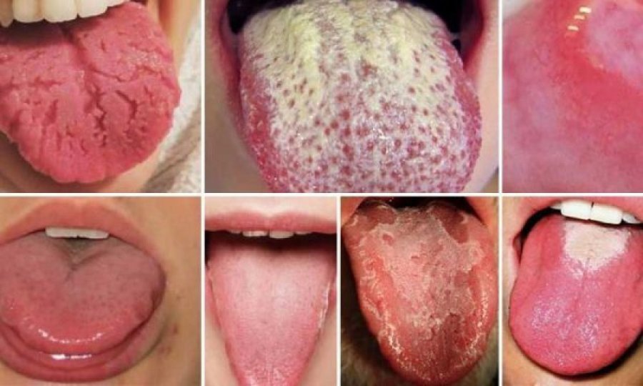Kanceri: Problemi ‘i zakonshëm’ i gojës duke rritur rrezikun e sëmundjes vdekjeprurëse