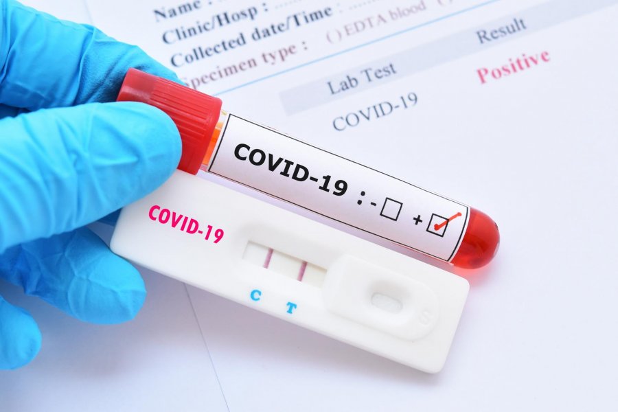  Disa komuna në Kosovë ndalin testimet për COVID-19 gjatë fundjavave 