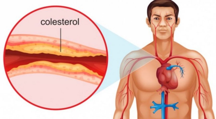  Ilaç i ri për uljen e kolesterolit mund të shpëtojë 30 mijë jetë 