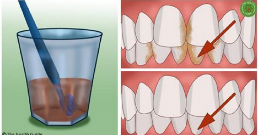 Pastroni dhëmbët me këtë përbërës, do të qeshni përherë