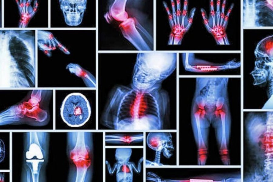 Njihuni me mënyrat si të përdorni qepët kundër artritit, reumatizmës dhe osteoporozës