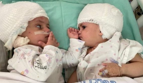  Operacion i rrallë, ndahen me sukses binjaket e lindura me kokë të ngjitur 