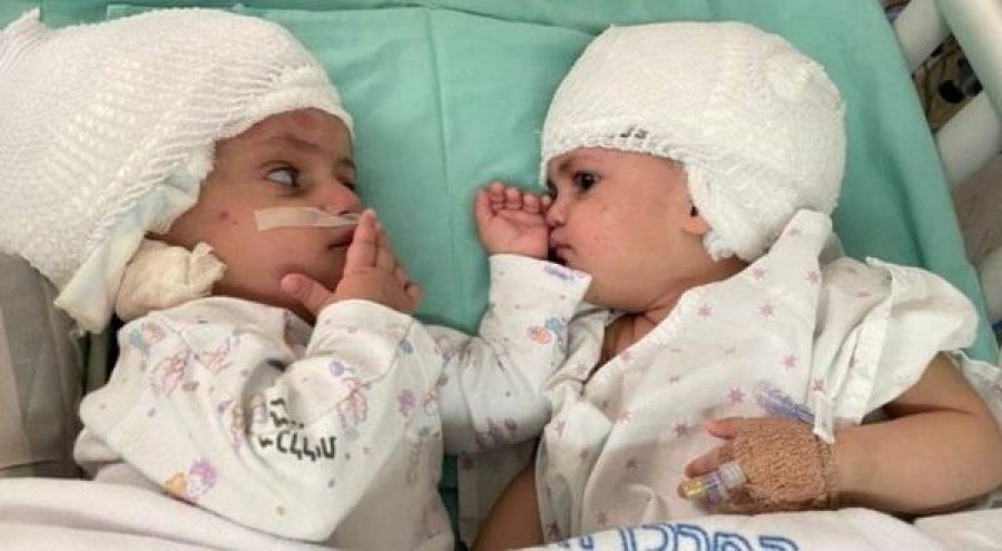  Operacion i rrallë, ndahen me sukses binjaket e lindura me kokë të ngjitur 