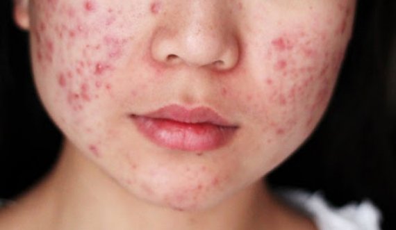 Nga puçrrat deri tek infeksionet, ja çfarë ndodh me lëkurën tuaj kur flini pa pastruar make up-in