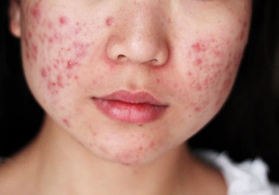 Nga puçrrat deri tek infeksionet, ja çfarë ndodh me lëkurën tuaj kur flini pa pastruar make up-in