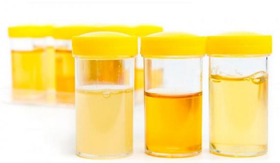 Ngjyra e urinës tregon gjithçka që duhet të dini për shëndetin tuaj 