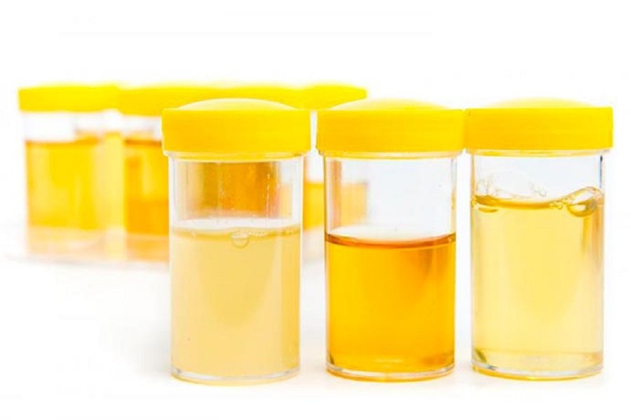 Ngjyra e urinës tregon gjithçka që duhet të dini për shëndetin tuaj 