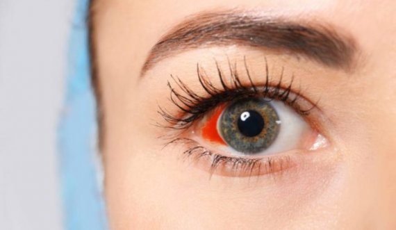 Keni gjurmë gjaku në sy? Cilat janë shkaqet dhe si të parandaloni plasjen e kapilarëve?