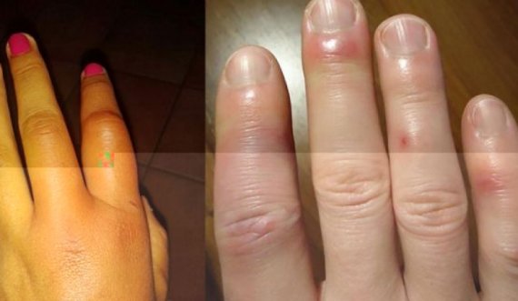 Arsyet kryesore pse keni gishta të fryrë