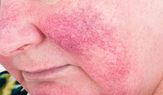 ​Cilat janë shkaqet e mundshme të rosacea