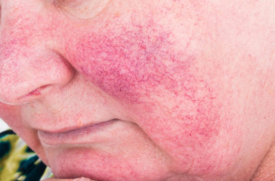 ​Cilat janë shkaqet e mundshme të rosacea