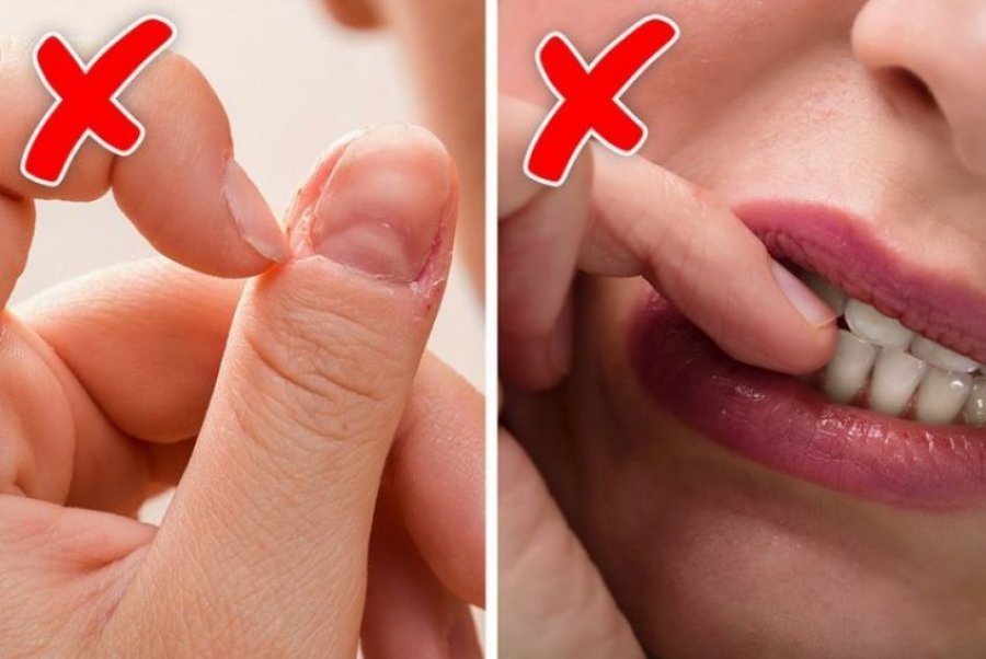 Dermatologët kanë 8 këshilla si ta ndaloni kafshimin e thonjve