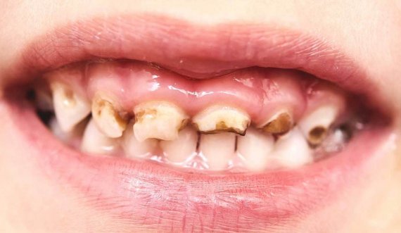 Çfarë ndodh nëse nuk i lani dhëmbët për pesë ditë