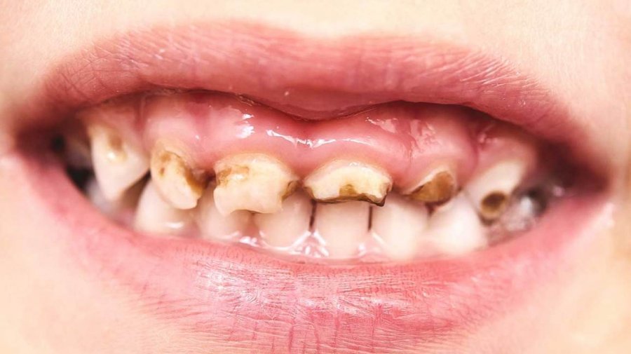 Çfarë ndodh nëse nuk i lani dhëmbët për pesë ditë