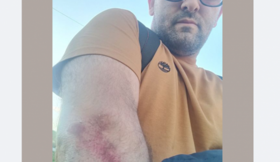 Shkëlzen Gashi sulmohet nga qentë endacakë: U rrëzova e u sakatova 