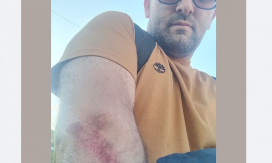 Shkëlzen Gashi sulmohet nga qentë endacakë: U rrëzova e u sakatova 