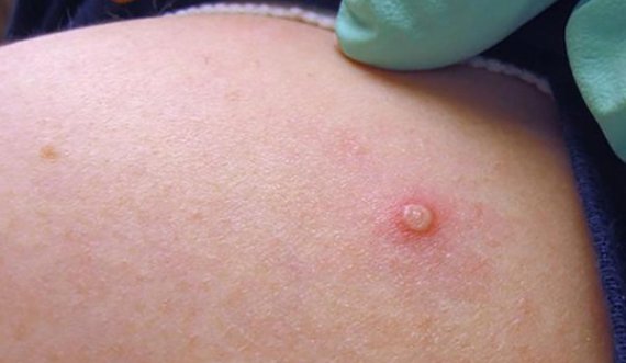 Dyfishohen të infektuarit me linë e majmunit në Serbi