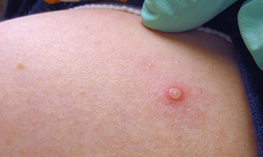 Dyfishohen të infektuarit me linë e majmunit në Serbi