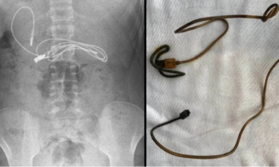 Mjekët ja heqin nga stomaku një kabull telefoni 15 vjeçarit